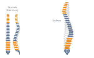 Symptom Skoliose Skelett mit Krümmungen Atlastherapie bei Skoliose